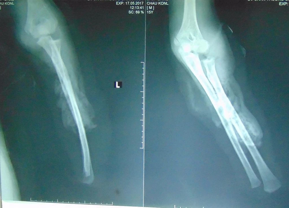 Kết quả chụp X-quang cho thấy cánh tay trái bệnh nhân bị đứt lìa và dập nát.