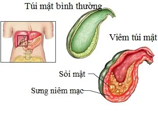 Bệnh ở túi mật và cách phát hiện sớm ảnh 1