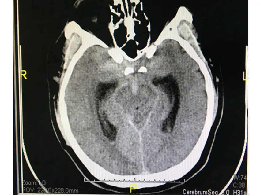 Tưởng đau đầu do làm đêm, té ra bị xuất huyết màng não ảnh 1 Tưởng đau đầu do làm đêm, té ra bị xuất huyết màng não ảnh 1