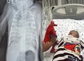 Bé 2 tháng tuổi phổi trắng xóa vì nhiễm lao từ cha 