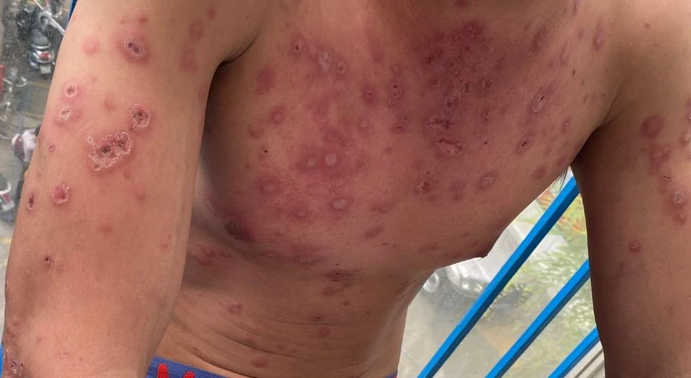 Cơ thể ông H. nổi nhiều dát, sẩn, mảng hồng ban do bị hội chứng Rowell. Ảnh: BVCC