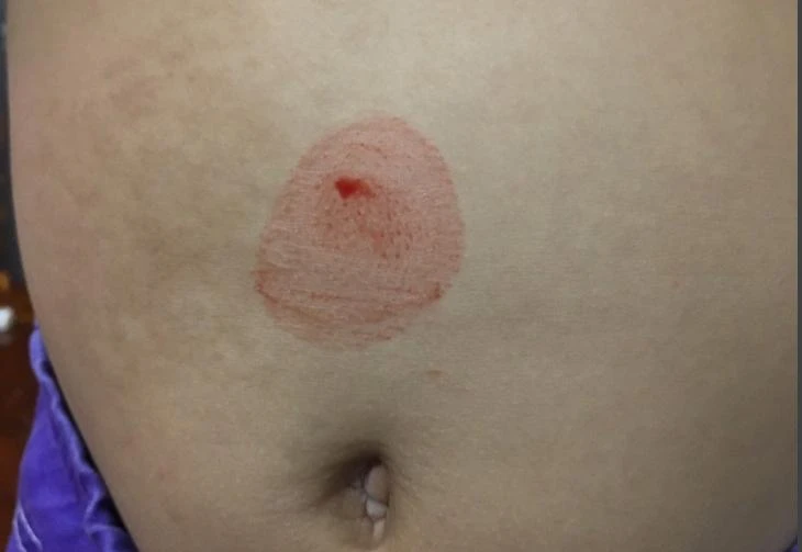 Mồ hôi vùng bụng bé gái 10 tuổi tiết ra lẫn máu. Ảnh: BVCC