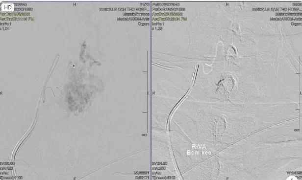 Hình chụp cho thấy anh Đ. bị dị dạng mạch máu tủy. Ảnh: BVCC Hình chụp cho thấy anh Đ. bị dị dạng mạch máu tủy. Ảnh: BVCC