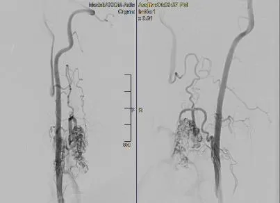 Hình ảnh mạch máu tủy của anh Đ. sau khi được can thiệp. Ảnh: BVCC Hình ảnh mạch máu tủy của anh Đ. sau khi được can thiệp. Ảnh: BVCC