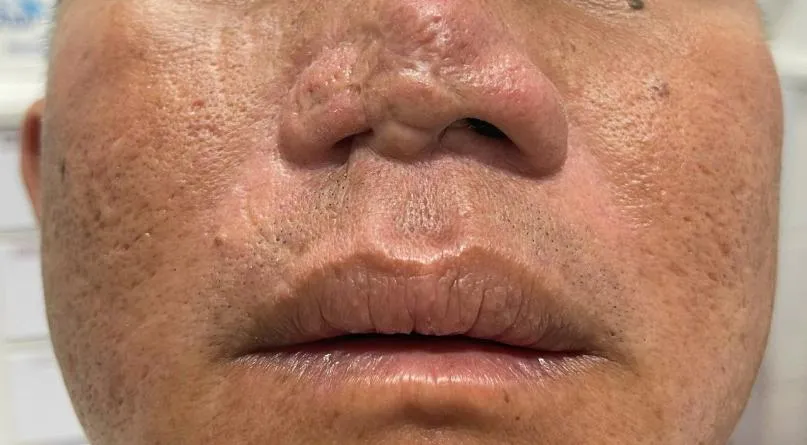 Cánh mũi phải ông V. bị co rút nên khó thở. Ảnh: TRẦN NGỌC