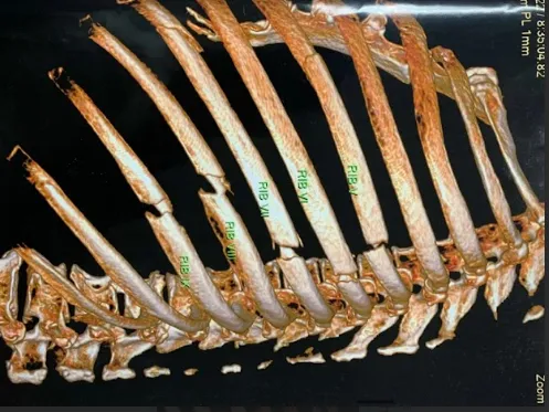 ông T bị gãy nhiều xương sườn sau tai nạn giao thông. Ảnh: BVCC ông T bị gãy nhiều xương sườn sau tai nạn giao thông. Ảnh: BVCC