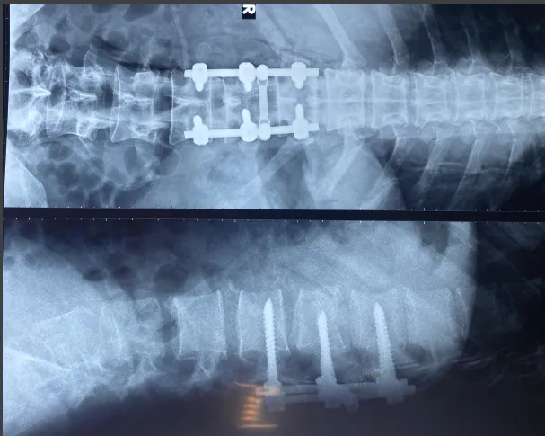 Bệnh nhân gãy cột sống thắt lưng hồi phục nhờ phương pháp cải tiến ảnh 1 Bệnh nhân gãy cột sống thắt lưng hồi phục nhờ phương pháp cải tiến ảnh 1
