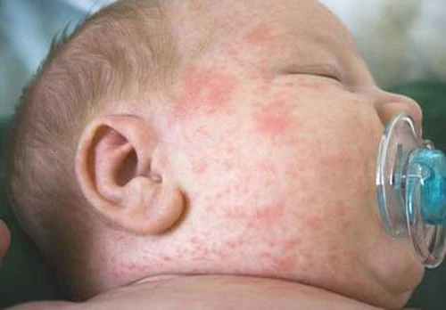 Lo sợ khi bé nổi ban ảnh 1