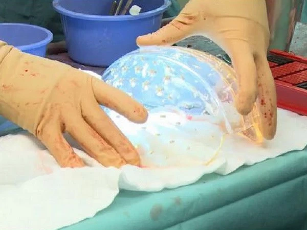 Cấy ghép thành công hộp sọ 3D cho một phụ nữ ảnh 1