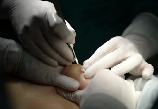 Cô Hui quyết định gặp bác sĩ để loại bỏ chúng. Ảnh: Daily Mail