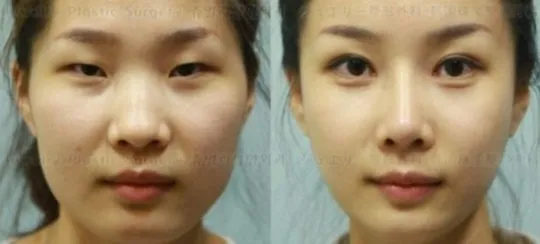 Nhập cảnh không được vì quá đẹp sau giải phẫu thẩm mỹ