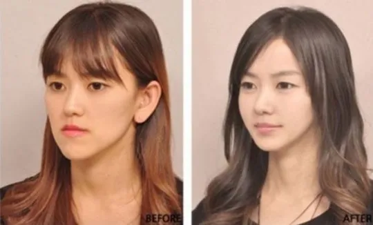 Cắt mí, nâng mũi là những ca phẫu thuật được bác sĩ Hàn Quốc thực hiện nhiều nhất