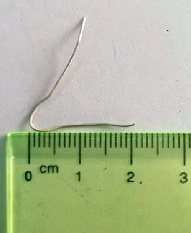 Nội soi lấy cọng kim loại trong phế quản bệnh nhân ảnh 1