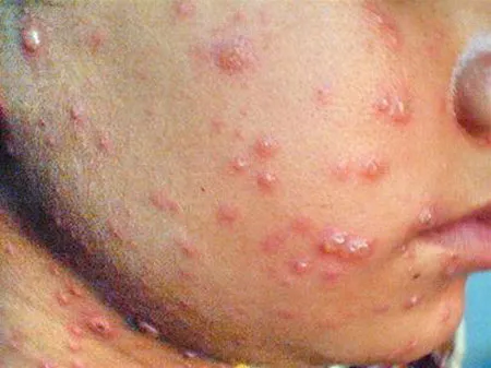 Các bệnh sốt phát ban: dễ nhầm lẫn! ảnh 1