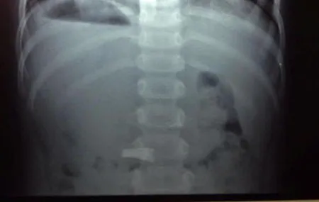 Kết quả chụp  X.Quang cho thấy chiếc cặp yên vị quay ngang trong dạ dày bé