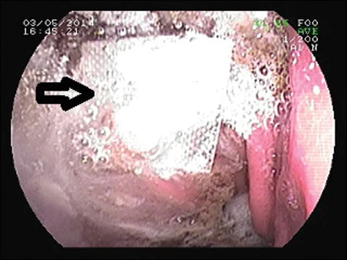 Suýt thủng ruột do uống thuốc còn nguyên vỉ ảnh 1