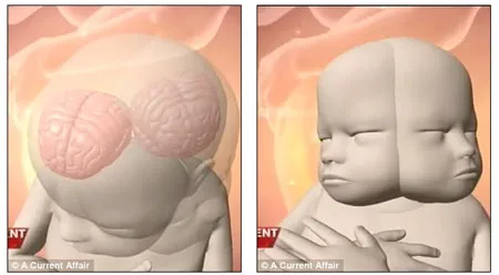 Trẻ sơ sinh có hai khuôn mặt ảnh 4 Về dị tật thai hai mặt