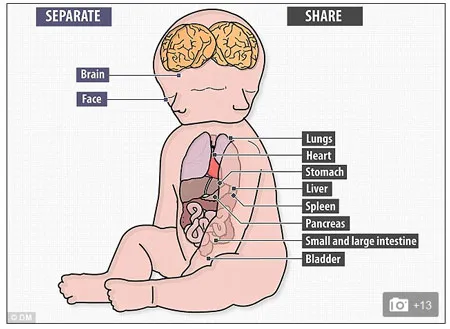 Trẻ sơ sinh có hai khuôn mặt ảnh 2 Hai bé ra đời sớm hơn 6 tuần so với dự kiến.