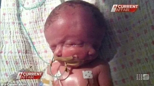 Bé sơ sinh hai mặt đã qua đời ảnh 1 Hy vọng và Niềm tin (Hope và Faith) chào đời vào ngày 8-5