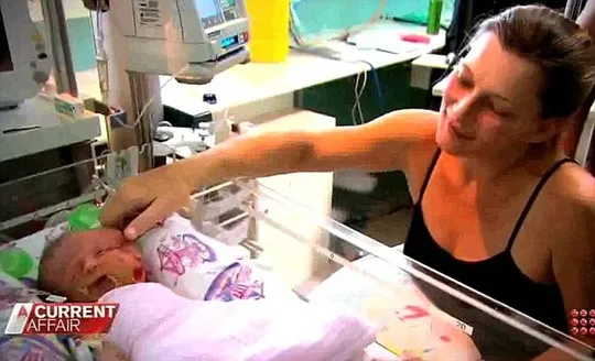 Bé sơ sinh hai mặt đã qua đời ảnh 2 Bé sơ sinh hai mặt đã qua đời