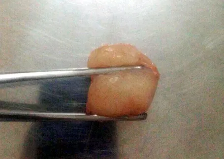 Quả vải gây ra cái chết thương tâm cho bé trai 6 tuổi