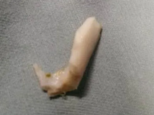 Loét thực quản sau nhiều ngày hóc xương heo