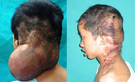 Khối u được giải phóng, trả lại hình dáng gần như nguyên vẹn cho chàng thanh niên. Ảnh: BS cung cấp