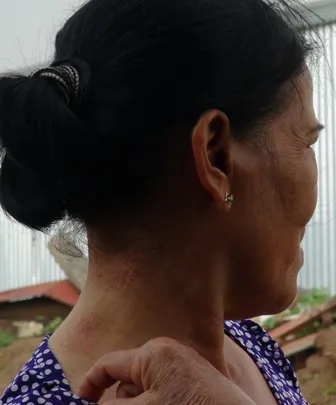 Bà Mười bị kiến ba khoang cắn gây thương tích ở cổ