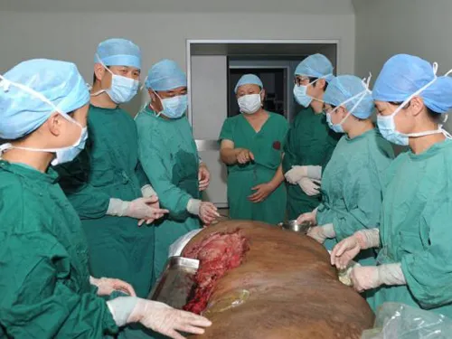 Người đàn ông mang khối u lớn nhất thế giới: 110 kg ảnh 4 Người đàn ông mang khối u lớn nhất thế giới: 110 kg