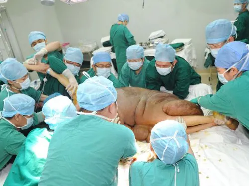 Người đàn ông mang khối u lớn nhất thế giới: 110 kg ảnh 5 Người đàn ông mang khối u lớn nhất thế giới: 110 kg