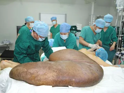 Người đàn ông mang khối u lớn nhất thế giới: 110 kg ảnh 6 Ca phẫu thuật cắt bỏ khối u cho anh Yang diễn ra trong suốt 16 giờ