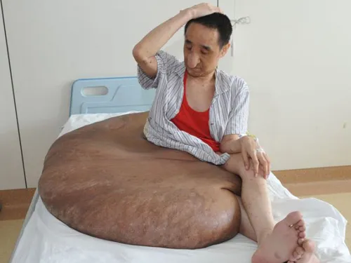 Người đàn ông mang khối u lớn nhất thế giới: 110 kg ảnh 1 Anh Yang và khối u 110 kg