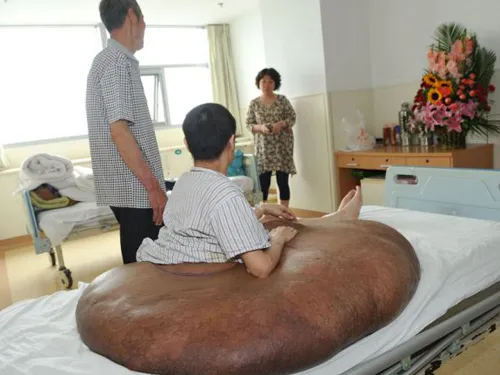 Người đàn ông mang khối u lớn nhất thế giới: 110 kg ảnh 3 Các bác sĩ ở Bệnh viện Bắc Kinh đã vô cùng ngạc nhiên trước kích cỡ khổng lồ của khối u.