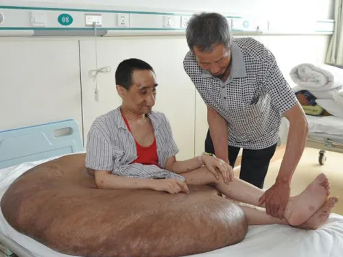 Người đàn ông mang khối u lớn nhất thế giới: 110 kg ảnh 2 Người đàn ông mang khối u lớn nhất thế giới: 110 kg