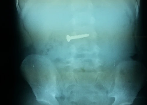 Phát hiện cây đinh dài 3 cm trong bụng bé 3 tuổi ảnh 1