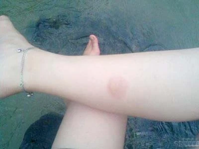 Sơ cứu khi bị bỏng bô xe máy ảnh 1 Sơ cứu khi bị bỏng bô xe máy