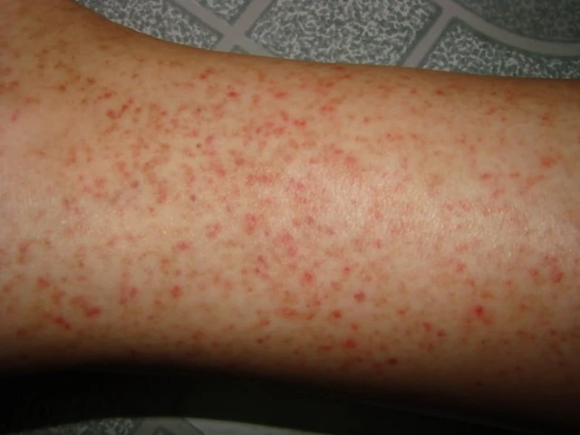 Dùng thuốc khi bị sốt xuất huyết 