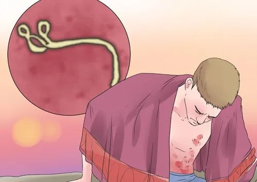 Ebola, virus Ebola, đại dịch Ebola, phòng và điều trị Ebola, biến chứng nguy hiểm của Ebola
