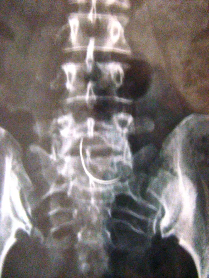 Cây kim trong bụng