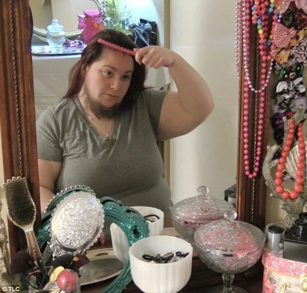 Mắc bệnh lạ, người phụ nữ mọc râu quai nón như đàn ông ảnh 2