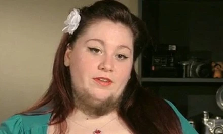 Mắc bệnh lạ, người phụ nữ mọc râu quai nón như đàn ông ảnh 1