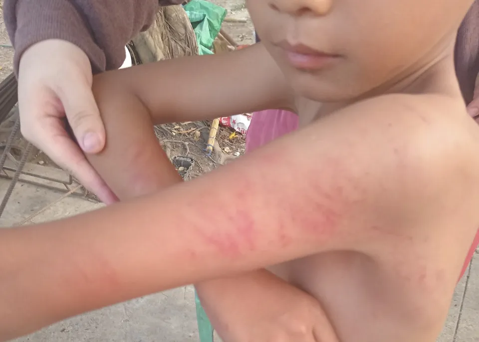 Học sinh lớp 1 bị cô giáo đánh với các vết bầm hiện trên da. Ảnh: CTV học sinh lớp 1 bị cô giáo đánh.JPG