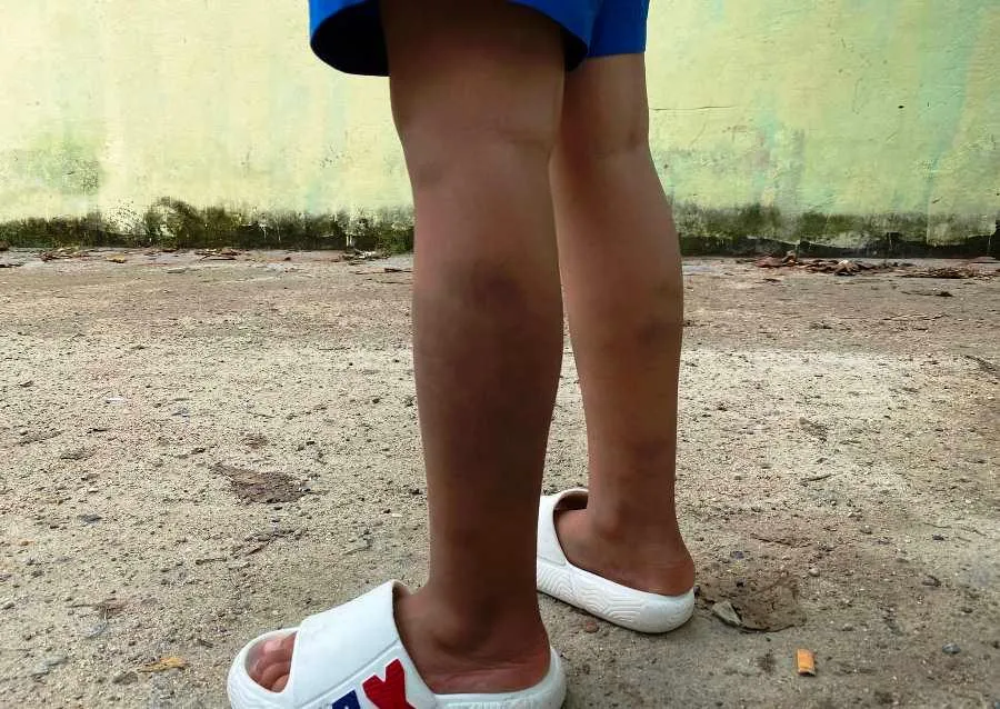Chân em học sinh lớp 1 vẫn còn bầm tím. Ảnh: HẢI HIẾU Chân em học sinh lớp 1 vẫn còn bầm tím. Ảnh: HẢI HIẾU