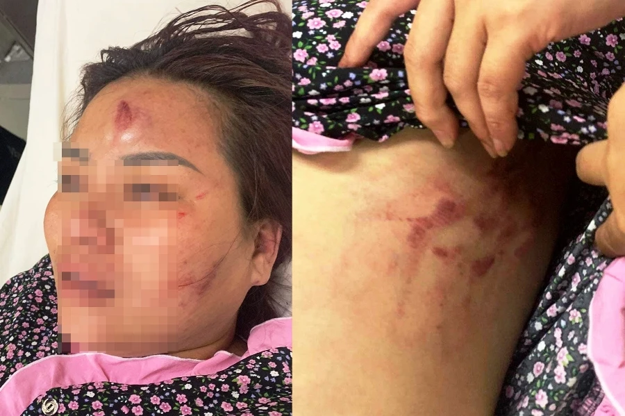 Vết thương chằng chịt trên cơ thể người vợ. Ảnh: Chị P cung cấp