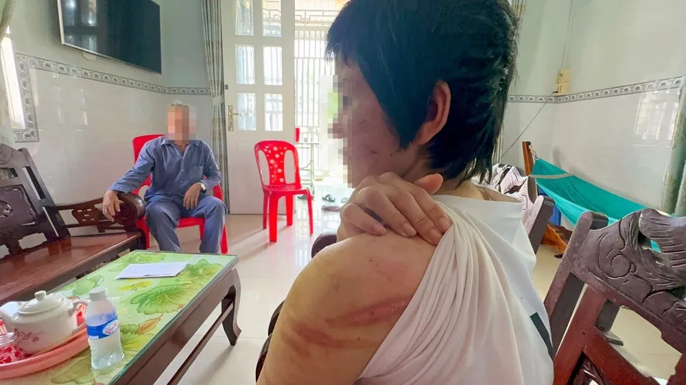 Chị G với chằng chịt vết thương do chồng bạo hành. Ảnh: AH Chị G với chằng chịt vết thương do chồng bạo hành. Ảnh: AH