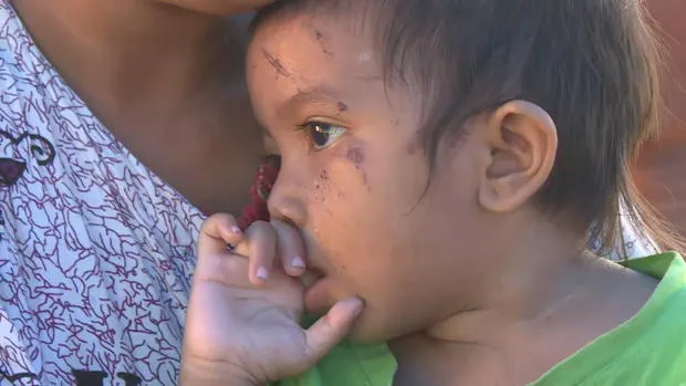 Mặt bé gái đầy vết sẹo sau khi bị sóng thần cuốn lăn tròn, nhưng vẫn sống sót thần kỳ. Ảnh: CBS NEWS