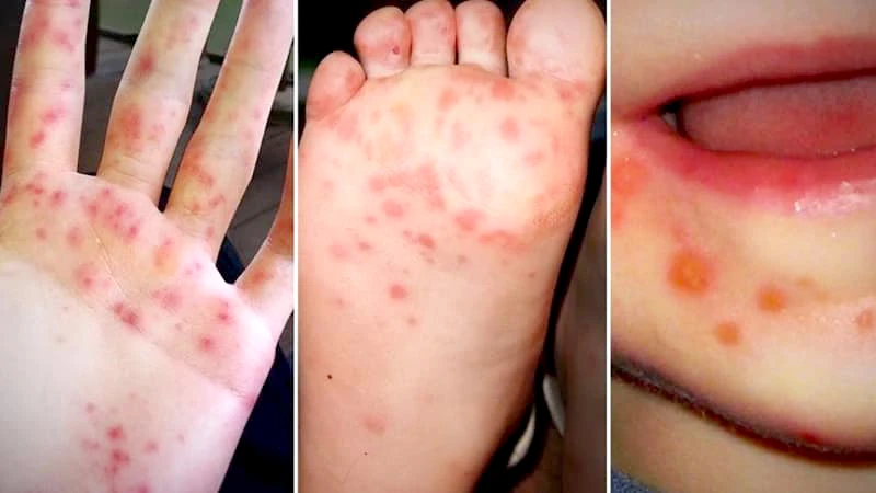 Ninh Thuận ra chỉ thị tăng cường phòng chống bệnh Tay chân miệng. Ảnh: B.V