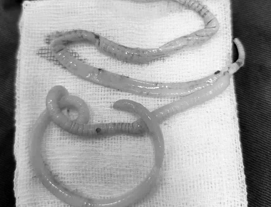 giun đũa đục thủng ruột non.jpg