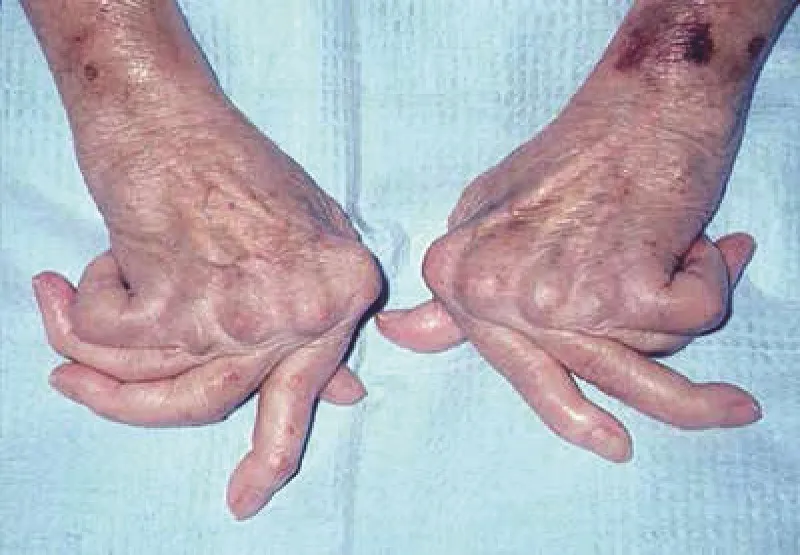 Viêm khớp dạng thấp gây ra nhiều tác dụng nguy hiểm. ẢNH:H.P