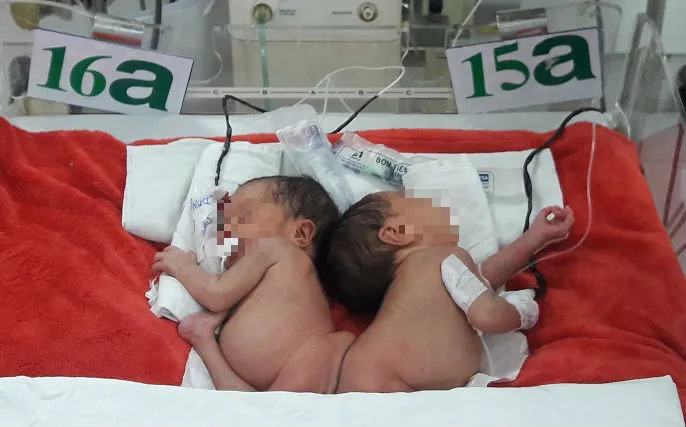 Chất lượng cuộc sống sau phẫu thuật tách dính sẽ không tốt ảnh 1 Hai bé sẽ được phẫu thuật tách rời khi tròn 3 tháng tuổi ẢNH: HÀ PHƯỢNG